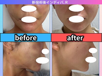 術後インディバ アール 新宿(R)の写真