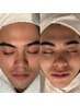 【会員価格】メンズ ヒゲ脱毛＋フェイシャル付き　ヒゲをなくして男を磨く！