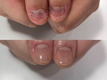 エスネイル(S-nail)/深爪矯正/自爪育成