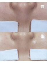 チョンダムビューティー(chondam beauty)/肌の黒ずみ、毛穴の開きにこれ!