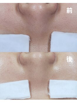 チョンダムビューティー(chondam beauty)/肌の黒ずみ、毛穴の開きにこれ!