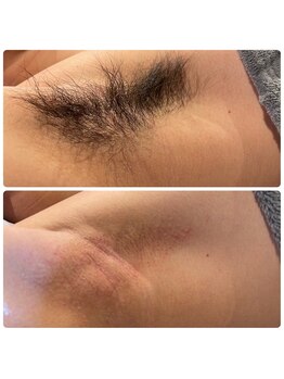 シエルボーイ(Cielboy)/両わきミックス脱毛は今日すぐ