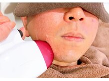 ベガ(Vega)/メンズLED脱毛