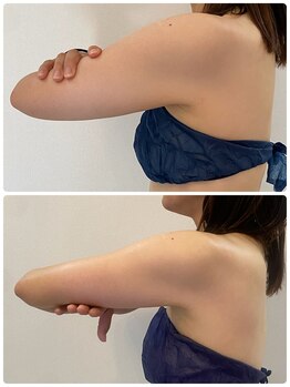 レミュ(Remu)/ブライダルエステ