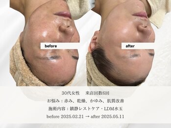 エメ 名古屋栄店(aimer)/SkinCare <肌管理・エイジング>