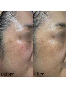 ヒール(heal)/症例