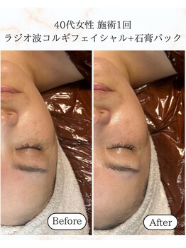 シーフェイス 横浜店(SEE FACE)/ラジオ波小顔コルギ+石膏パック