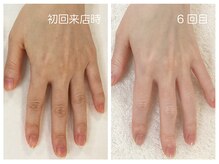 キレイテ 福岡天神店/関節や手肌のくすみ