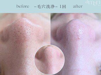 スキンラボアメリ(skin lab. ameri)/韓国式３D毛穴洗浄