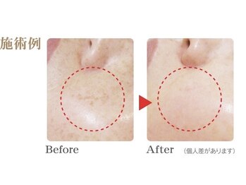 ランソ ビューティー 成田(RUNSO Beauty)/結果重視！本気のシミケア