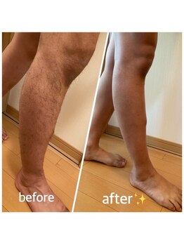 セルフ脱毛サロン SELFMADE イオンタウン仙台泉大沢店【3/29 NEW OPEN(予定)】 /【ビフォーアフター】セルフ脱毛