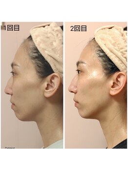 イル 名取店(iru)/糸式リフトアップフェイシャル