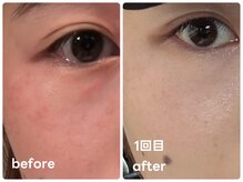 レアビューティー(Le'a beauty)/深いお悩みにララショット敏感肌