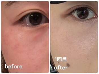 レアビューティー(Le'a beauty)/深いお悩みにララショット敏感肌