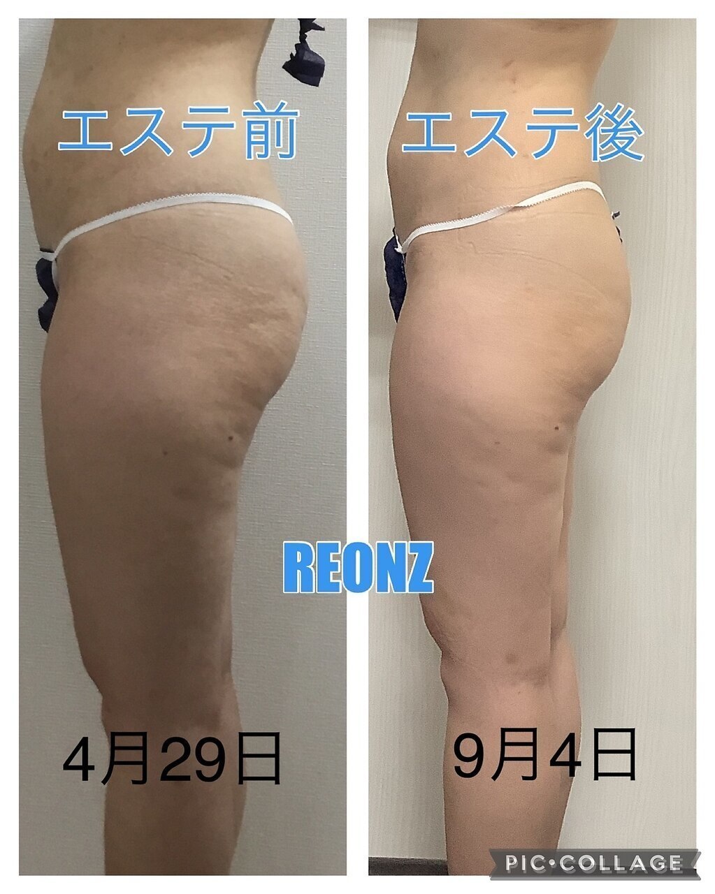 脂肪を溶かす エステ 私は2ヶ月で10キロ落ちました