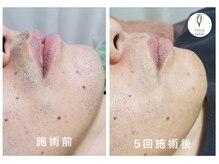 ヴォアール 名古屋店(VOIR)/メンズ脱毛　ヒゲ脱毛