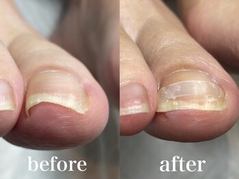 ドクターネイル爪革命 札幌本店/症例紹介11 巻き爪