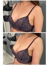 カナエルサロン 旭川(KANAERU SALON)/【バストアップ】症例☆