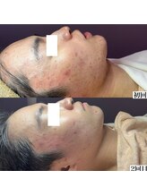 フェミナ(femna)/ポテンツァフェイシャル