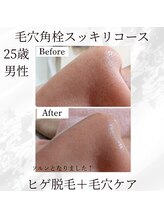 ミヤビ(MIYABI)/１回の施術結果