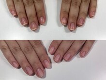 エスネイル(S-nail)/深爪矯正/自爪育成