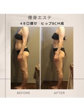 ムーン(MOON)/痩身エステbefore→after