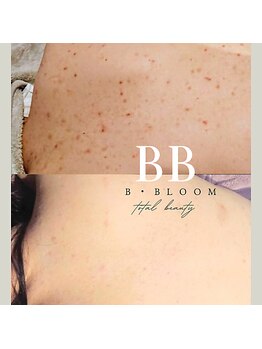 ビー ブルーム(B BLOOM)/【ニキビケア】繰り返さない肌へ