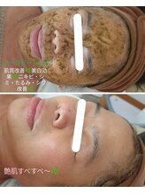 エム(M)/大人気ハーブピーリング