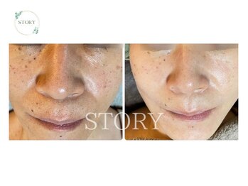 ストーリー(STORY)/ハーブピーリング専門店STORY