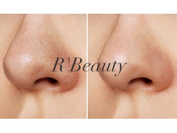 アールビューティー 東新宿店(R’Beauty)/皮脂詰まり徹底オフ全顔毛穴洗浄