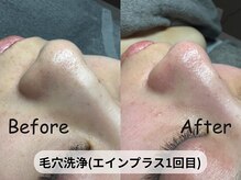 アルピナ(ALPINA)/毛穴洗浄1回目