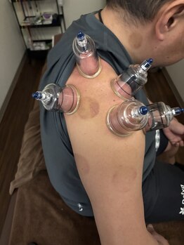 ほぐせる スター鍼灸接骨整体院 竹ノ塚 竹ノ塚東口駅前店/吸い玉!