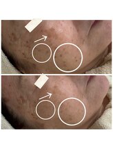 ビースキン(be-skin)/シミケアbefore→after