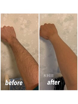 セルフ脱毛サロン SELFMADE イオンタウン仙台泉大沢店【3/29 NEW OPEN(予定)】 /【ビフォーアフター】セルフ脱毛