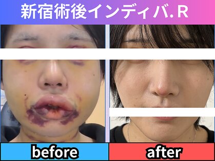 術後インディバ アール 新宿(R)の写真
