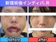 術後インディバ アール 新宿(R)の写真