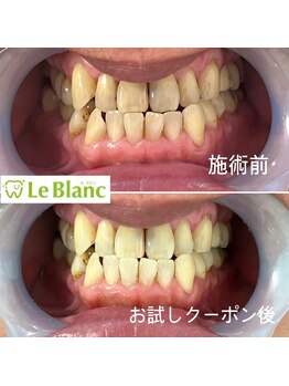 ルブラン 奈良店(Le Blanc)/初めてのホワイトニング!