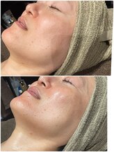 グロー(GLOW)/BBLフェイシャル