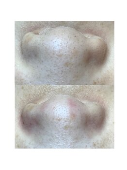 カンパニュラ(campanula)/#毛穴エクストラクション