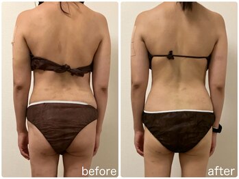 リリィブラン(Lily branc)/痩身/背中+腰ウエスト