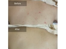 ルアナインフィニティ(Luana∞)の雰囲気（お背中も美肌革命！素肌に自信を☆至近距離に自信が◎）