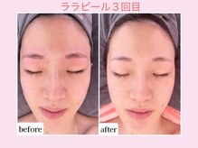 カレン アイビューティー(Karen Eyebeauty)/ララピール３回目☆