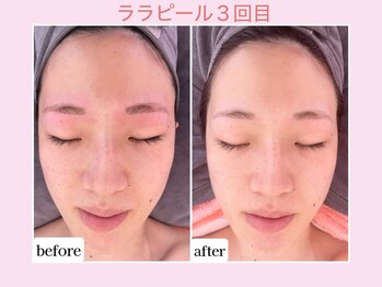 カレン アイビューティー(Karen Eyebeauty)/ララピール３回目☆