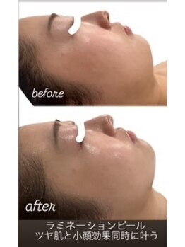 シャンディ(Shandy)/ラミピール☆ビフォーアフター