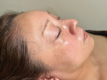 ベリンダ(BELINDA)の写真/【剥離/ダウンタイムなし】次世代低刺激ピーリング☆お肌を育てて根本改善<ラミネーションピール>