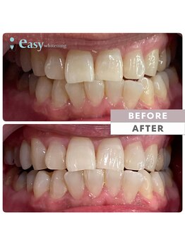 イージーホワイトニング 五反田店(easy whitening)/セルフホワイトニング症例写真