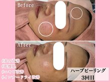 エンクリニカルラボ 三宮店(E&N CLINICAL LABO)/毛穴洗浄+アンプル+モデリング