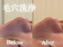 アールエーサロン 恵比寿 広尾(Ra salon)/毛穴洗浄1回での変化！