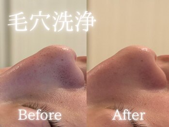 アールエーサロン 恵比寿 広尾(Ra salon)/毛穴洗浄1回での変化!