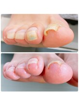 アモーレ プラス トゥエンティフォー(Amore +24)/巻爪の爪切り